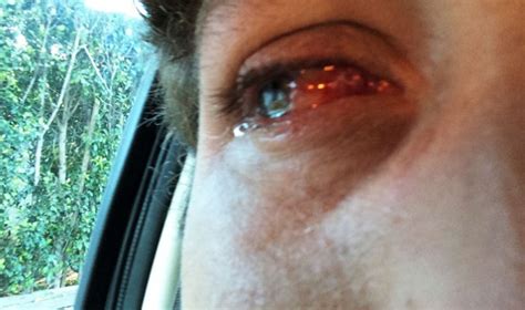 I Got A Pterygium Cut Out Of My Eyeball And I Learned These 20 Things