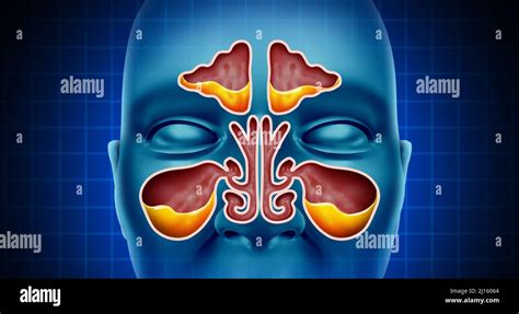 Sinus Infection And Sinusitis Illness As A Nasal Cavity Blockage