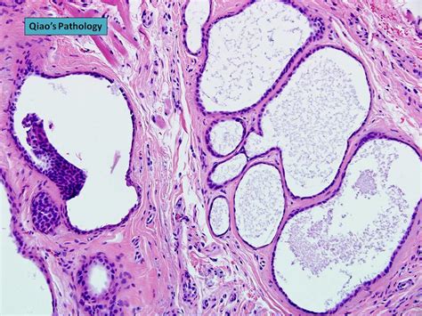 All Sizes Qiaos Pathology Apocrine Hidrocystoma Molls Gland Cyst