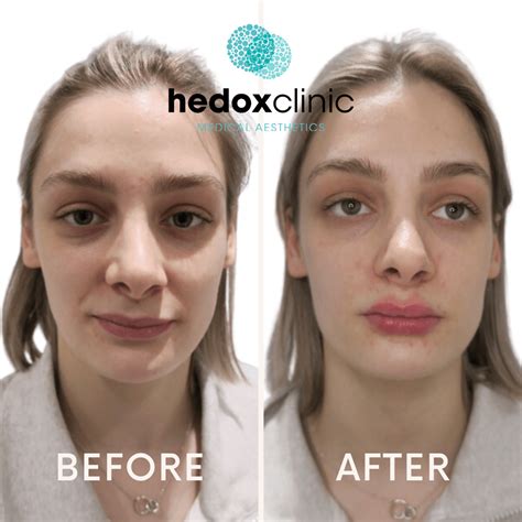 Facial Asymmetry Treatment London Hedox Clinic