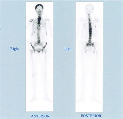 Treatment Of Severe Hypocalcaemia Due To Osteoblastic Metastases In A