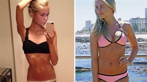 I Didnt Want To Be The Anorexic Girl Woman Reveals How She Won