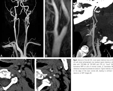 Figure 4 From Evaluation Of Carotid Artery Stenosis With Multisection