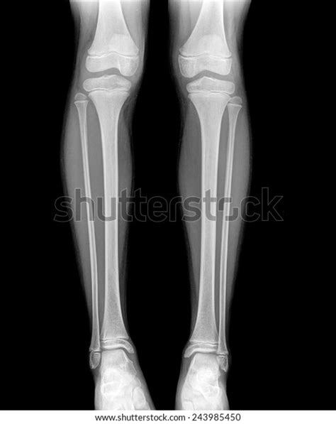8716件の「human Leg Xray」の画像、写真素材、ベクター画像 Shutterstock