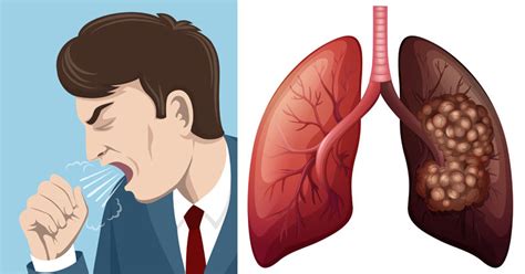 8 Early Warning Signs Of Lung Cancer You Should Know