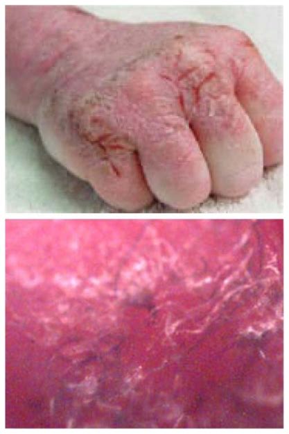 Morgellons Disease Note Painful Ulcerating Lesions On