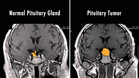 Medical Moment Brain Tumors Video 1 Of 2 Youtube