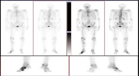 Whole Body Bone Scan With Areas Of Increased Tracer Uptake Download