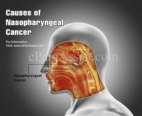 Nasopharyngeal Cancerstagescausessymptomstreatmentsurvival Rate