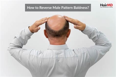 How To Reverse Male Pattern Baldness
