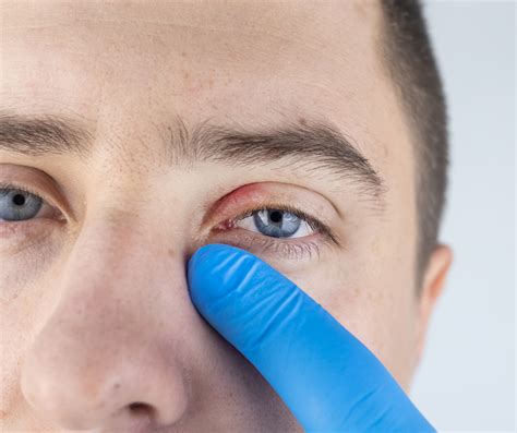Eyelid Disease Blepharitis