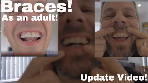 Getting Braces As An Adult Update Youtube