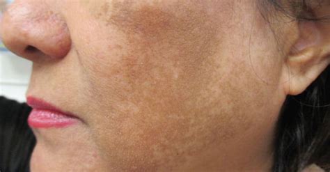 Treating Acne In Dark Skinned People