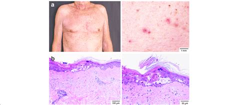 Skin Findings After The Second Course Of Ipilimumab Treatment A