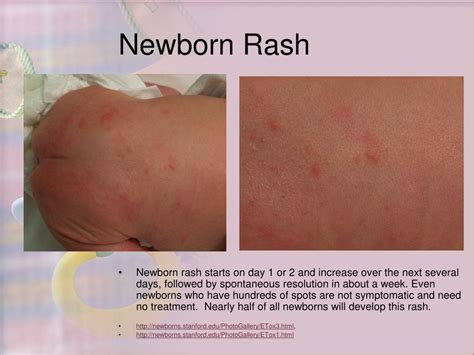 Newborn Rashes And Skin Conditions