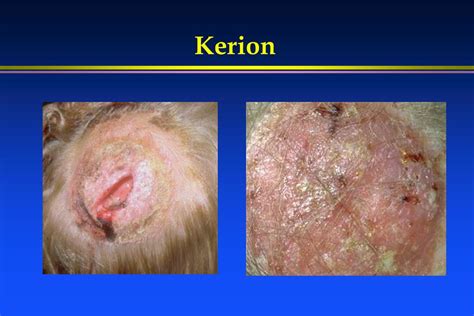 Ppt Fungal Infections Of The Skin And Nails Powerpoint Presentation