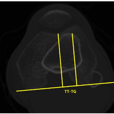 A Sulcus Angle Sa B Lateral Trochlear Inclination Lti Medial