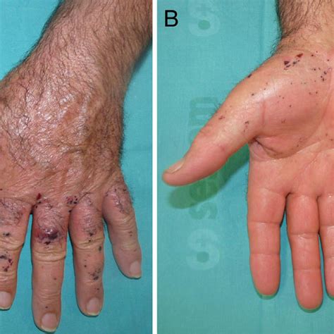 A Hemorrhagic Papules And Vesicles On The Dorsum Of The Fingers Case