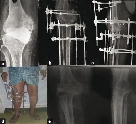 Salvage Of Infected Total Knee Arthroplasty With Ilizarov External