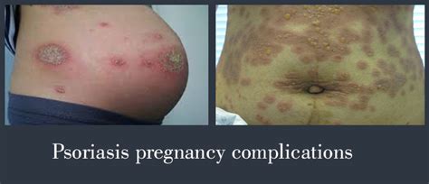 Psoriasis Pregnancy Complications Psoriasis Expert