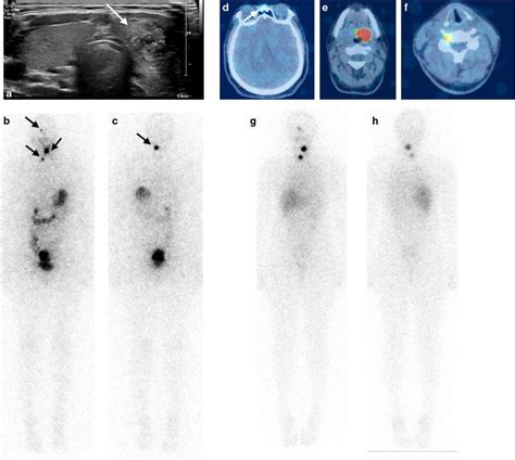 Multifocal Papillary Thyroid Carcinoma With Osseous Metastases