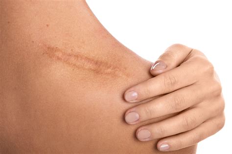 Top 3 Common Questions About Keloid Scars Dr Hm Liew Skin Clinic