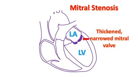 What Is Mitral Stenosis All About Heart And Blood Vessels