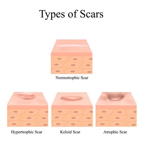 Med Spa Treatments For Scar Reduction And Removal Annapolis And
