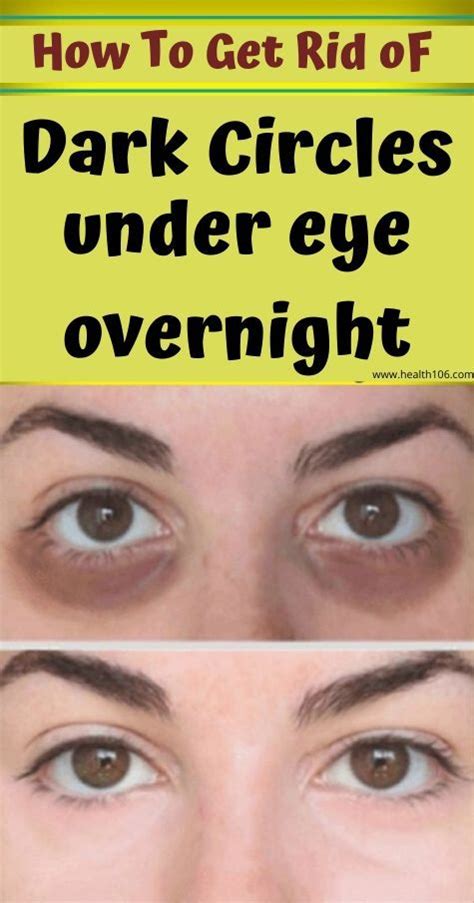 How To Get Rid Of Dark Circles Under Eyes Overnight ~ Skincare