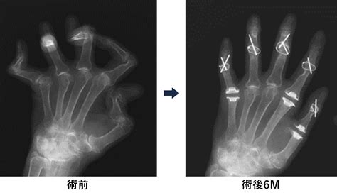 関節リウマチの領域│浜松医科大学 整形外科学講座(医師・医学 ...