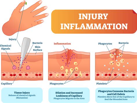 Inflamatorio Moderado No Preventivo