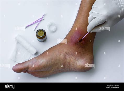 Infected Leg Wound Hi Res Stock Photography And Images Alamy