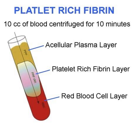 Platelet Rich Fibrin Therapy Dr Michael A Castillo Md