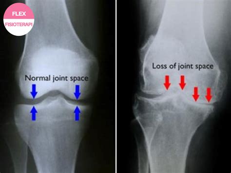 Flex Physiotherapy Perbezaan Antara Sakit Lutut Osteoarthritis Dengan