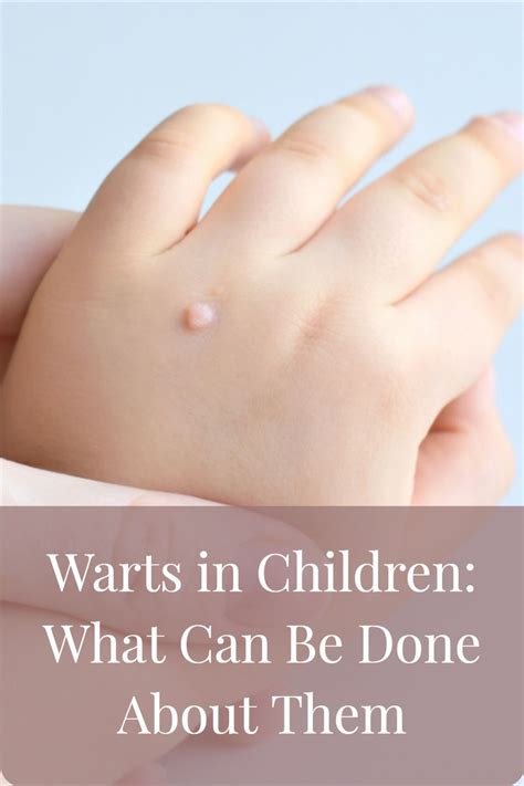Warts In Children What Can Be Done About Them Artofit