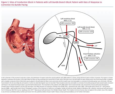 Defining Left Bundle Branch Block Patterns In Cardiac Resynchronisation
