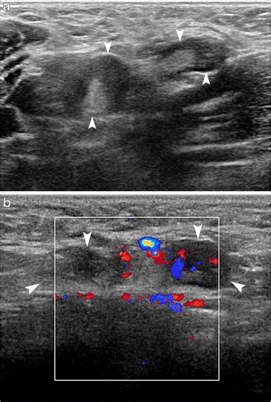Sonographic Appearance Of Bilateral Axillary Lymphadenopathy