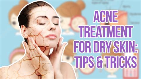 Acne Treatment For Dry Skin Tips And Tricks Youtube