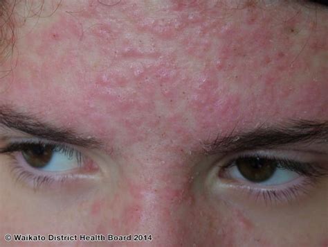 Steroid Acne Dermnet Nz Steroid Acne Acne Skin Diseases