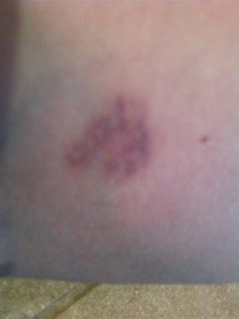 I Have Small Purple Circular Rings On My Calf Each Are Maybe