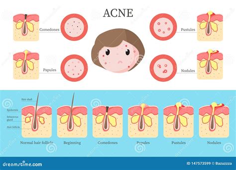 Acne Types Anatomy Pimple Diseases Sectional View Blackhead Cystic