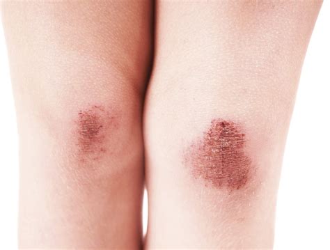 The Best Treatments For Skin Abrasion Health Cautions