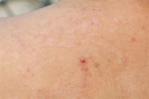 Psoriasis Dermatitis Skin Stock Image Image Of Blister Background