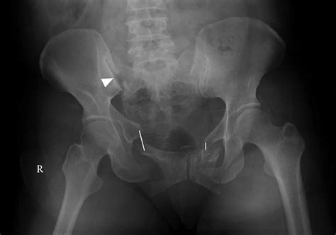 Pelvis Ap X Ray Of 66 Year Old Female White Arrow Indicates Sacral