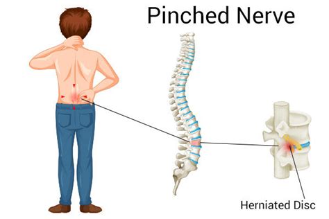 Pinched Nerve Physical Therapy Chiropractic Chart Ubicaciondepersonas