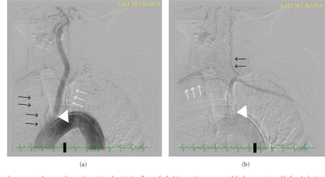 Figure 4 From Bilateral Subclavian Steal Syndrome Semantic Scholar