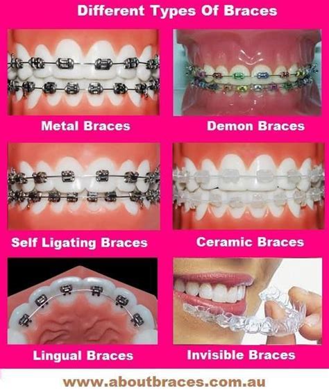 Different Types Of Braces Philbin And Reinheimer Orthodontics In Annapolis Maryland And
