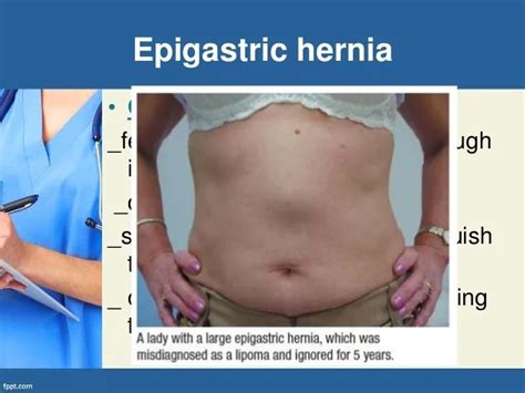 Epigastric Abdominal Hernia Symptoms Prnso