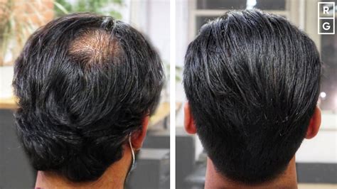 Details More Than 53 Best Hairstyle For Balding Crown Ineteachers