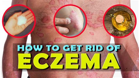 How To Get Rid Of Eczema On Face Fast